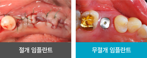 ���� vs ������ ���ö�Ʈ