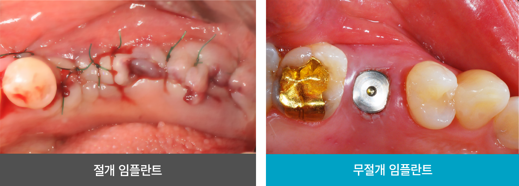 ���� vs ������ ���ö�Ʈ