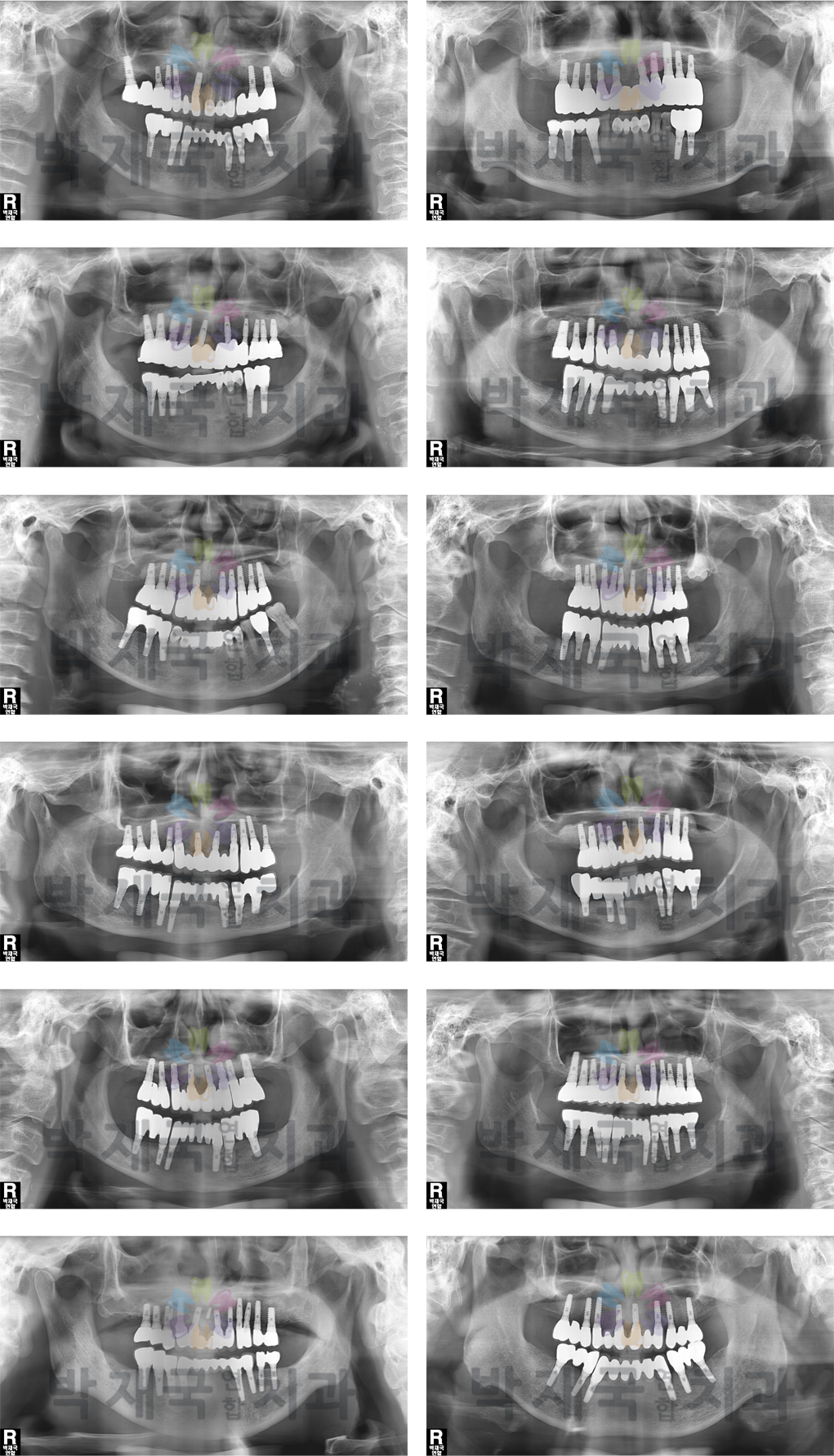 ��ü ���ö�Ʈ ���